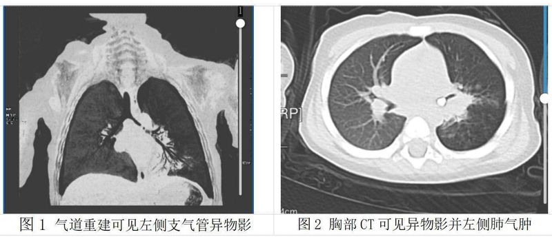  从一岁宝宝乳牙呛入气道看隐患；反复肺炎背后真相曝光；家长春节必备防护与急救全攻略。 健康养生