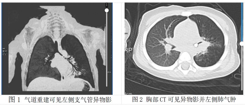  从一岁宝宝乳牙呛入气道看隐患；反复肺炎背后真相曝光；家长春节必备防护与急救全攻略。 健康养生
