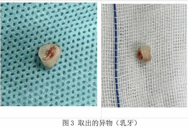  从一岁宝宝乳牙呛入气道看隐患；反复肺炎背后真相曝光；家长春节必备防护与急救全攻略。 健康养生