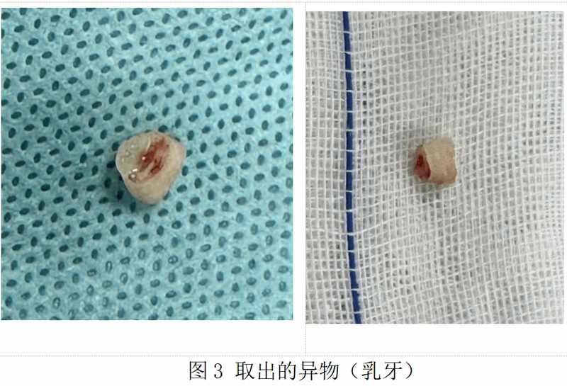  从一岁宝宝乳牙呛入气道看隐患；反复肺炎背后真相曝光；家长春节必备防护与急救全攻略。 健康养生